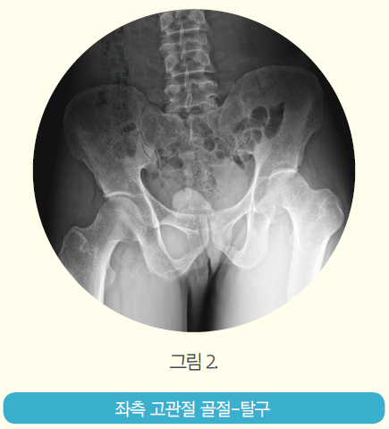 그림 2 -좌측 고관절 골절-탈구