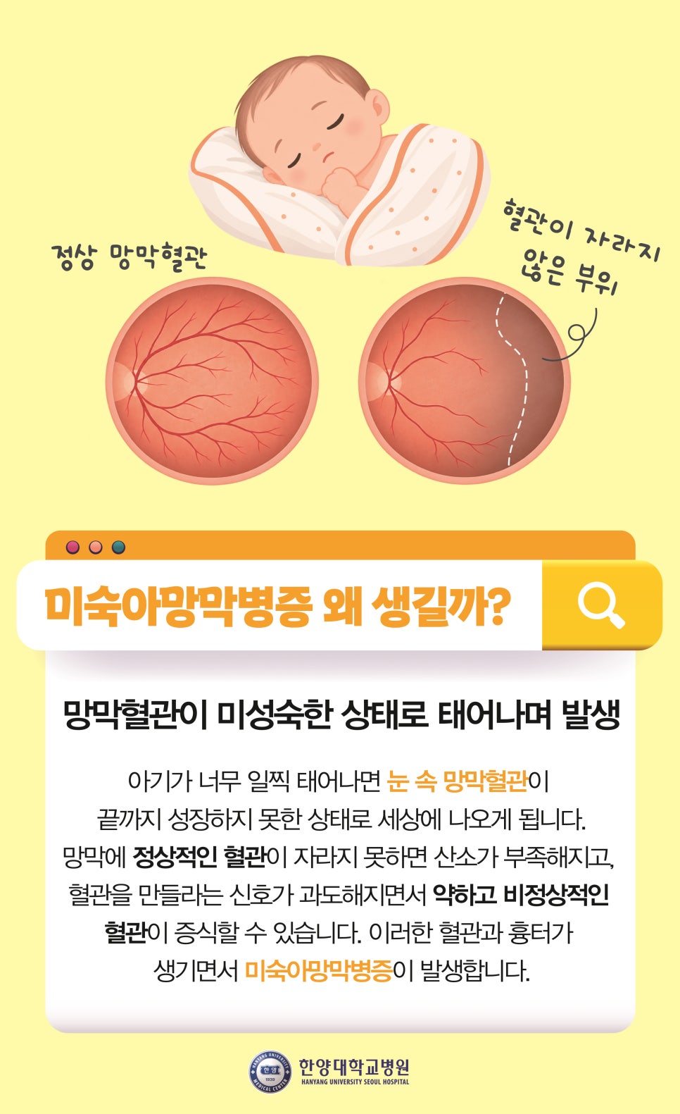 미숙아에게 꼭 필요한 눈 검사, 미숙아망막병증 바로 알기