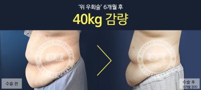 고도비만의 가장 효과적인 치료 방법, '수술'!