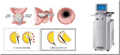 한양대학교의료원, 전립선비대증 레이저 수술기 홀렙(HoLEP) 도입