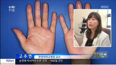 주부 습진 방치하면 우울증까지...초기 대처가 중요