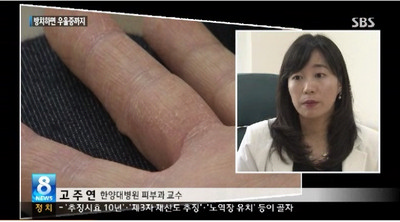 물집 고통 손 습진, 놔뒀다가 우울증까지