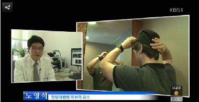 탈모…오해와 진실