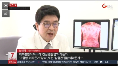 [뉴스7] 겨울철에 심해지는 건선… 올바른 치료는?