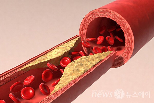 ‘나쁜’ LDL 콜레스테롤 수치, 심근경색·뇌졸중 겪으면 70 미만으로 낮춰야