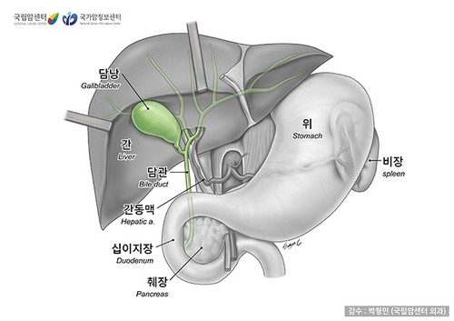 살찔수록 위험 커지는 '담낭암'…여성 비만은 더 치명적