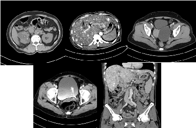 Abdomen Ct ë³µë¶€ ê²€ì‚¬ ê²€ì‚¬ ìˆ˜ìˆ  ì •ë³´ í•œì–'ëŒ€í•™êµë³'ì›