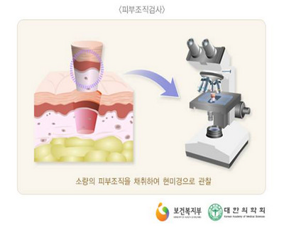 피부 생검 - 검사/수술 정보 - 한양대학교병원