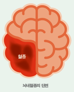 뇌내혈종의 단면