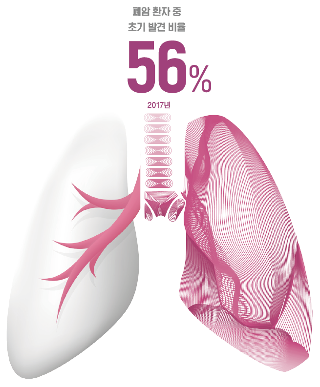 폐암 환자 중 초기 발견 비율 56%(2017년)