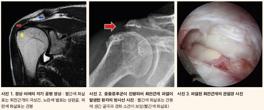 사진1.정상 어깨 MRI / 사진2. 충돌증후군 진행으로 회전근개 파열 발생 어깨 방사선촬영 / 사진3. 파열된 회전근개 관절경