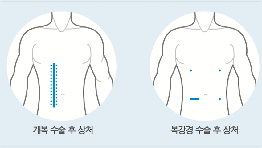 개복 수술과 복강경 수술 후 흉터 비교