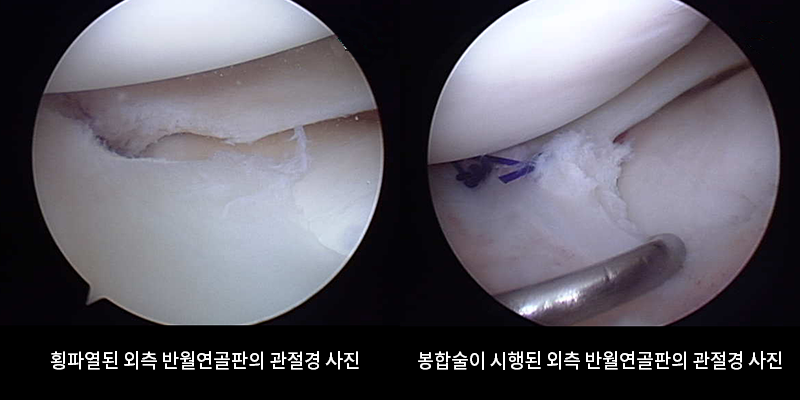 반월연골판 봉합술, (좌)횡파열된 외측 반월연골판의 관절경 사진, (우)봉합술이 시행된 외측 반월연골판의 관절경 사진