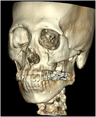 성형외과 안면골골절수술