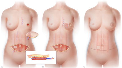 성형외과 복부피판을 이용한 유방재건술