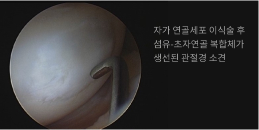 자가 연골세포 이식술후 섬유-초자연골 복합체가 생성된 관절경 소견