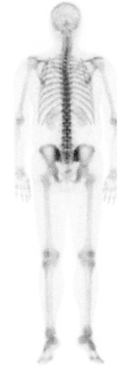 핵의학과 뼈 관절 스캔 정량 영상
