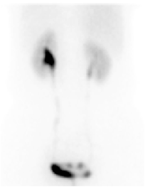 핵의학과 왼쪽 수신증으로 시행한 MAG3 신장 스캔 영상