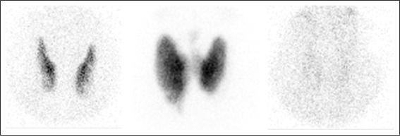  갑상선 영상의 예: (왼쪽) 정상   (중간) 그레이브 병   (오른쪽) 아급성 갑상선염 